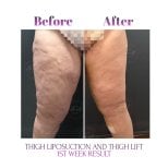 Vorher-nachher-Ergebnis Oberschenkelstraffung und Liposuktion bei Db'est Clinic, 1. Woche