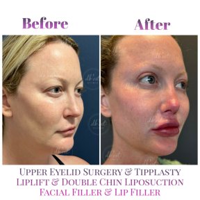 Vorher-nachher-Ergebnisse der Gesichtsverjüngung bei Db'est Clinic: Lid, Tipplasty, Filler