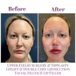 Vorher-nachher-Ergebnisse der Gesichtsverjüngung bei Db'est Clinic: Lid, Liplift, Filler