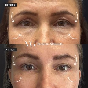Before and after upper and lower eyelid surgery results at VG Plastic Surgery clinic