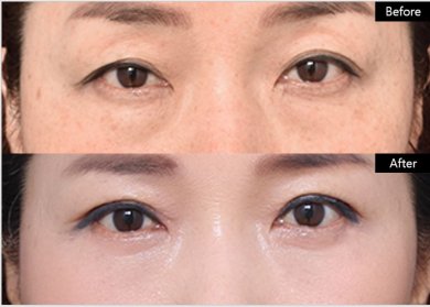 Before and after upper and lower eyelid surgery results at VG Plastic Surgery clinic