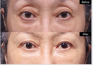Before and after upper and lower eyelid surgery results at VG Plastic Surgery clinic