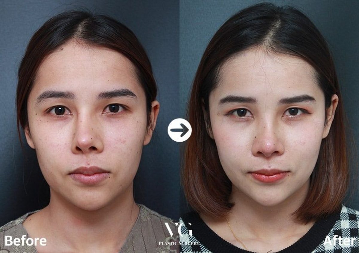 نتائج قبل وبعد عملية تجميل الأنف التصحيحية في VG Plastic Surgery، تحسين شكل الأنف