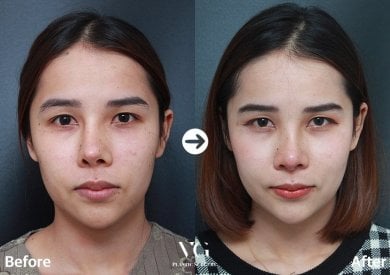 Before and after revision rhinoplasty results at VG Plastic Surgery, improved nose shape