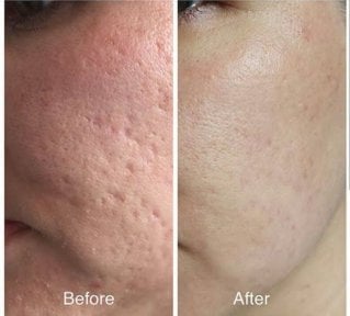 Before and after acne laser treatment results at ID Clinic Bangkok, smoother skin texture