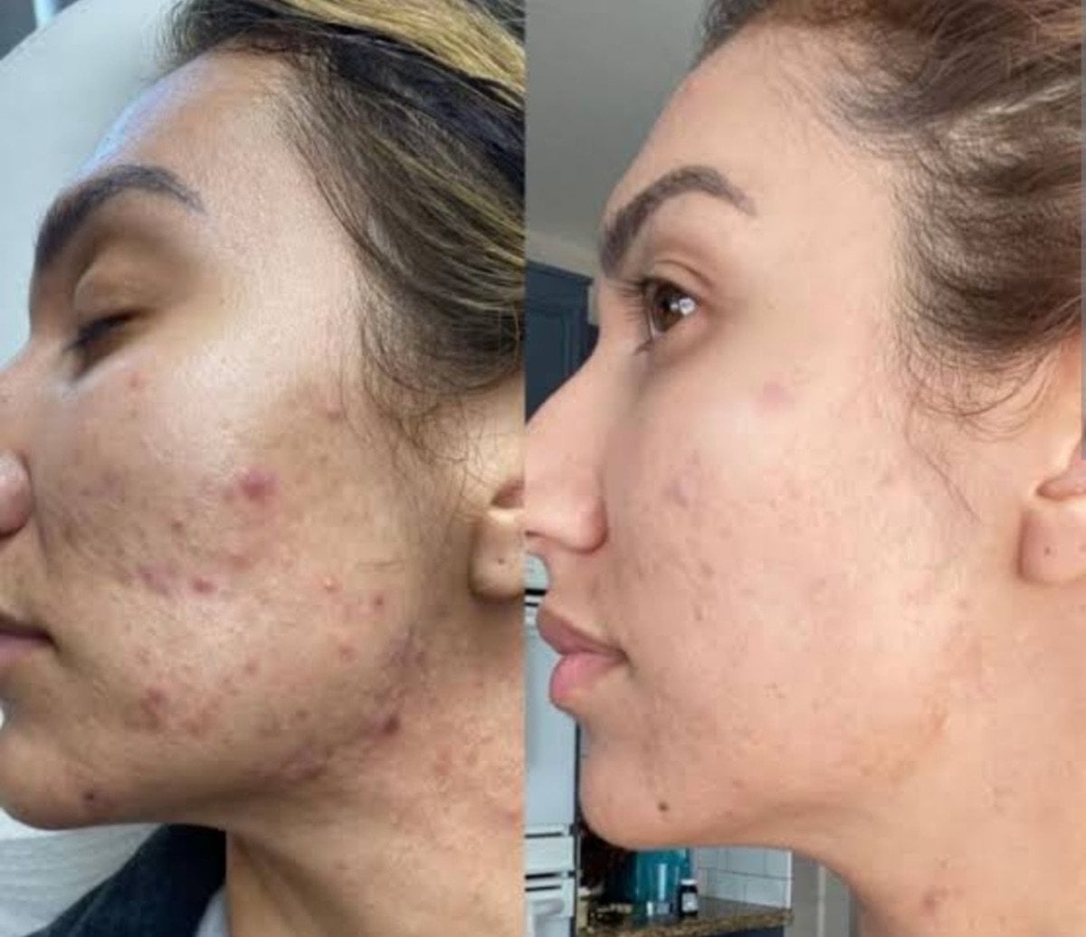 نتائج علاج حب الشباب بالليزر قبل وبعد في ID Clinic Bangkok، تحسن صفاء البشرة