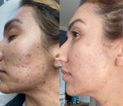 Before and after acne laser treatment results at ID Clinic Bangkok, clearer skin improvement