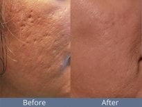 Before and after acne laser treatment results at ID Clinic Bangkok, smoother skin texture