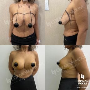 Before and after breast lift results at Lokman Hekim Istanbul Hospital, improved breast contour