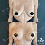 Before and after breast lift results at Lokman Hekim Istanbul Hospital, improved breast contour