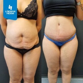 Before and after tummy tuck results at Lokman Hekim Istanbul Hospital, improved abdominal contour