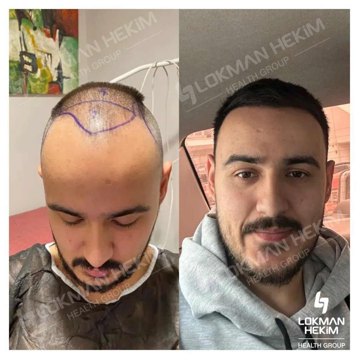 نتائج زراعة الشعر FUE قبل وبعد في مستشفى لوكمان حكيم إسطنبول، استعادة خط الشعر