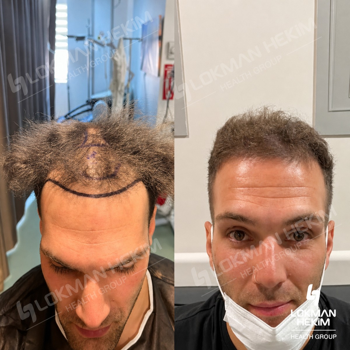 نتائج زراعة الشعر FUE قبل وبعد في مستشفى لقمان حكيم إسطنبول، خط شعر أكثر كثافة