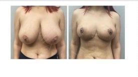 Before and after breast reduction results at Dr. Safa Manav Clinic, improved breast contour