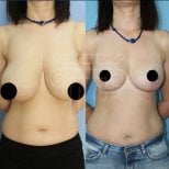 Before and after breast reduction results at Dr. Safa Manav Clinic, improved breast contour
