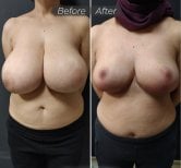 Before and after breast reduction results at Dr. Safa Manav Clinic, visible size reduction