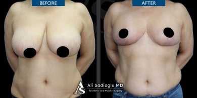 Before and after breast reduction results at Dr. Safa Manav Clinic, improved breast contour