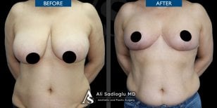 Before and after breast reduction results at Dr. Safa Manav Clinic, improved breast contour
