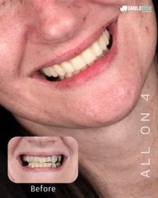 نتيجة قبل وبعد زراعة الأسنان All-on-4 في SmileBox Dental Clinic فرع تونغلور