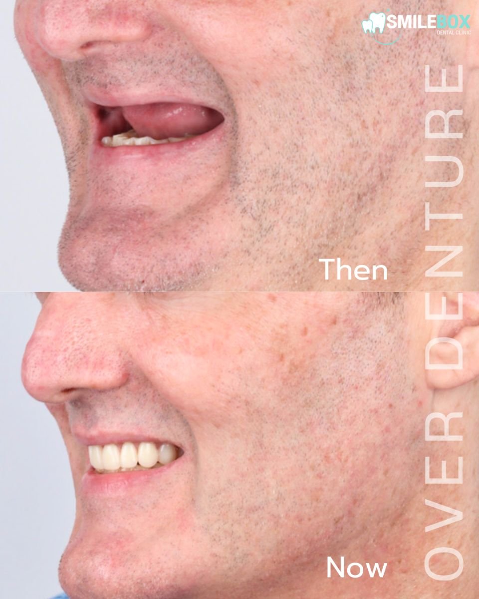 Resultados antes y después de implantes dentales All-on-4 en SmileBox Dental Clinic Thonglor