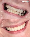 Before and after All-on-4 dental implants result at SmileBox Dental Clinic - Thonglor branch