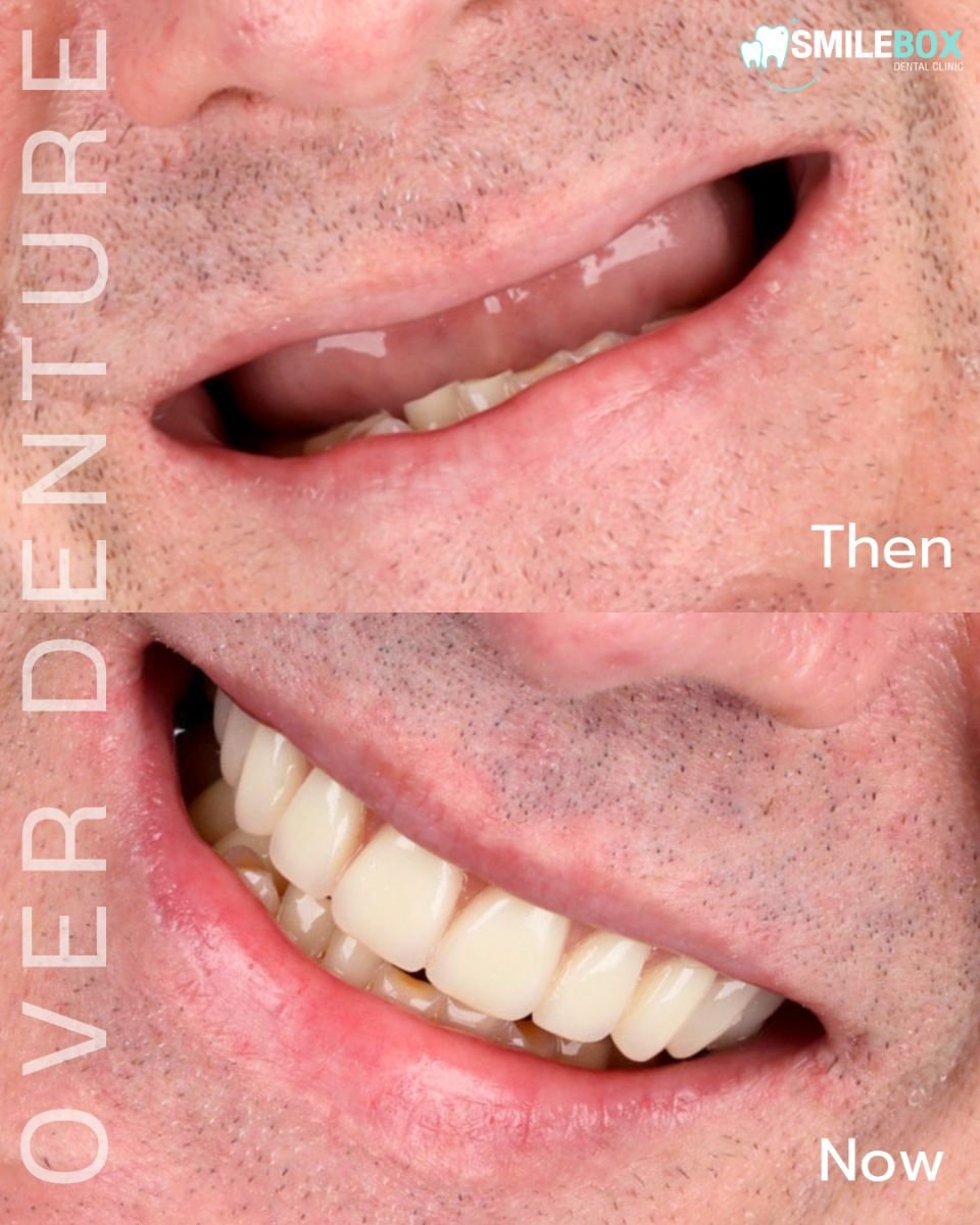 نتيجة قبل وبعد زراعة الأسنان All-on-4 في SmileBox Dental Clinic فرع ثونجلور