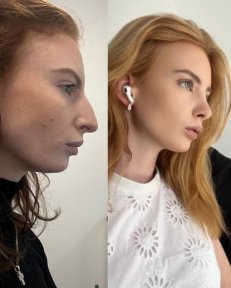 Efekty przed i po rhinoplastyce w Prof. Dr. Murat Songu Clinic, korekta nosa