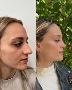 Efekty przed i po rhinoplastyce w Prof. Dr. Murat Songu Clinic, naturalny kształt nosa