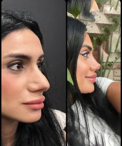 Efekty przed i po rhinoplastyce w Prof. Dr. Murat Songu Clinic, wysmuklony profil nosa