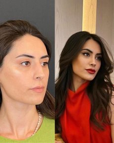 Efekty przed i po rhinoplastyce w Prof. Dr. Murat Songu Clinic, wysmuklony nos