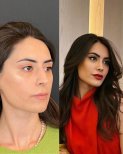 Efekty przed i po rhinoplastyce w Prof. Dr. Murat Songu Clinic, wysmuklony nos