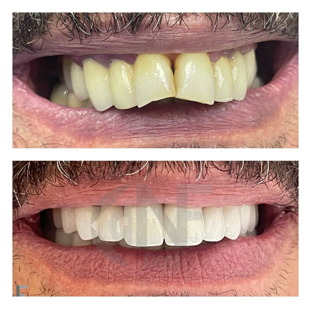 Resultado antes y después de implantes All-on-6 en Nifa Dent International, sonrisa mejorada