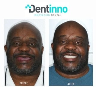 Результат до та після імплантації All-on-6 у Dentinno Dental Clinic, відновлена посмішка