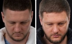 Before and after FUE hair transplant at Yurchenko Plastic Surgery Team, improved hair density result
