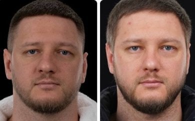Before and after rhinoplasty results at Yurchenko Plastic Surgery Team, improved nose shape