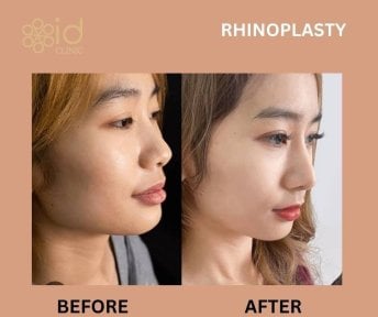 Before and after revision rhinoplasty results at ID Clinic Bangkok, improved nose profile