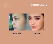 Before and after rhinoplasty result at ID Clinic Bangkok, nose reshaping with natural look