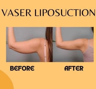 Before and after Vaser liposuction arm contouring results at ID Clinic Bangkok