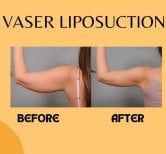 Before and after Vaser liposuction arm contouring results at ID Clinic Bangkok