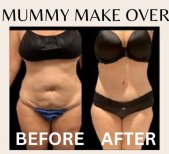 Before and after tummy tuck results at ID Clinic Bangkok, improved abdominal contour