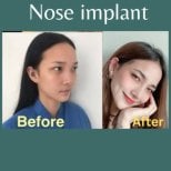Before and after nose implant results at ID Clinic Bangkok, improved nose shape and contour