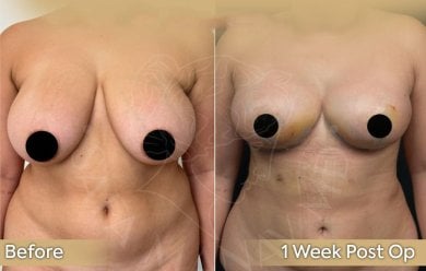 Before and after breast reduction results at Dr. Safa Manav Clinic, 1 week post-op