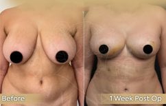 Before and after breast reduction results at Dr. Safa Manav Clinic, 1 week post-op