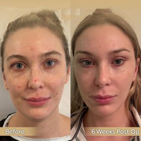 Brow Lift Vorher-Nachher-Ergebnis bei Dr. Safa Manav Clinic, sichtbare Augenverjüngung