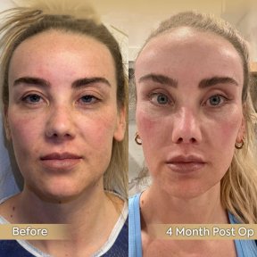 Facial feminization surgery before and after results at Dr. Safa Manav Clinic, 4 months post-op