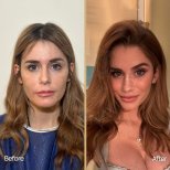 Facial feminization surgery before and after results at Dr. Safa Manav Clinic, enhanced femininity