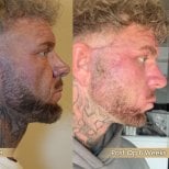 Neck lift before and after results at Dr. Safa Manav Clinic, visible jawline and neck contour