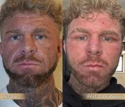 Before and after neck lift results at Dr. Safa Manav Clinic, visible jawline improvement