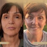 Vorher-nachher-Ergebnis Brauenlifting bei Dr. Safa Manav Clinic, sichtbare Stirnstraffung