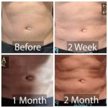 Результати ліпосакції до і після в Asia Cosmetic Hospital, помітний контур живота